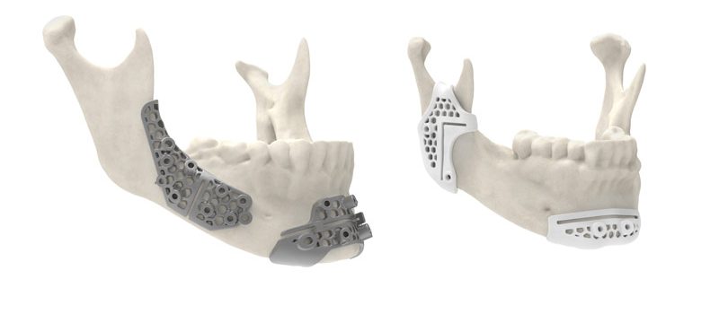 کاربرد پرینتر سه بعدی در جراحی